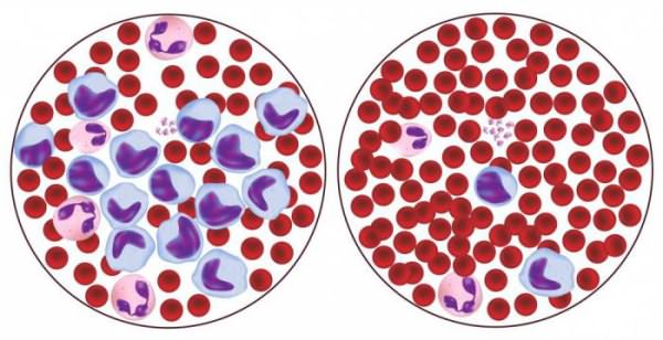 лимфоциты в крови повышены 