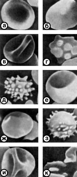 Рис. 2. Различные формы эритроцитов, выявляемые при сканирующей электронной микроскопии: а, б — дискоцит; в — дискоцит с гребнем; г — дискоцит с множественными выростами; д — эритроцит в виде тутовой ягоды; е — куполообразный эритроцит; ж — сферический эритроцит (гладкий); з — сферический эритроцит с выростами; и — эритроцит в виде спущенного мяча; к — дистрофически измененные эритроциты; ×3600