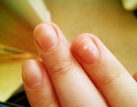 белые пятна на ногтях рук