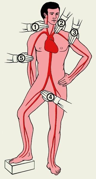 Схематическое изображение мест прижатия основных артерий на теле человека при кровотечении: 1 — общей сонной; 2 — подключичной; 3 — подмышечной; 4 — бедренной; 5 — плечевой