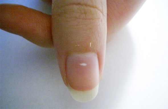 Что означают белые пятна на ногтях (590x382, 33Kb)