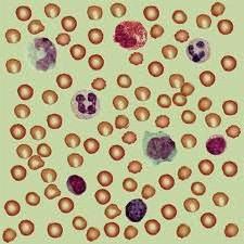 пониженное содержание лейкоцитов в крови