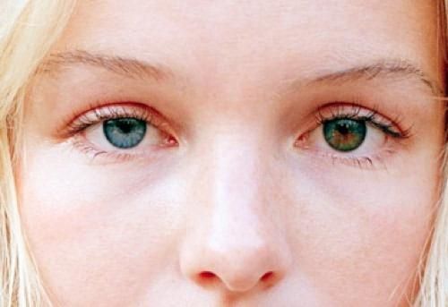гетерохромия глаз как сделать