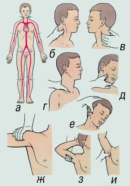 Рис. 2. Метод временной остановки (пальцевое прижатие) артериального кровотечения: а — схема расположения магистральных артерий и точек их прижатия (указаны стрелками); б, в — прижатие общей сонной артерии; г — прижатие подключичной артерии; д — прижатие наружной челюстной артерии; е — прижатие височной артерии; ж, з — прижатие плечевой артерии; и — прижатие подмышечной артерии