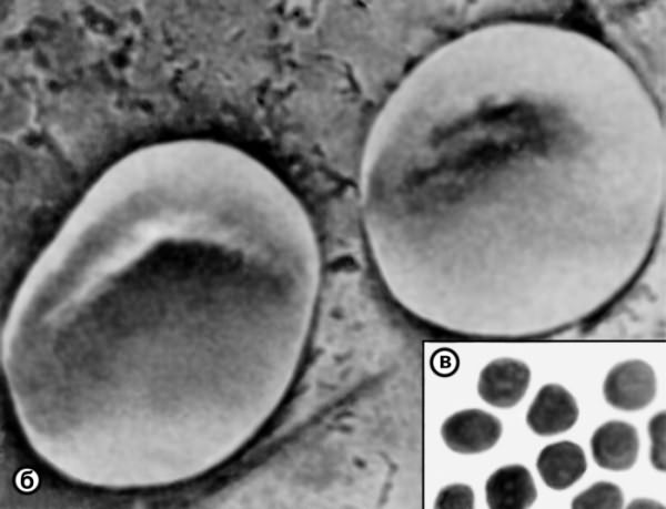 Рис. 1б,в). Микрофотография эритроцитов: б — при сканирующей электронной микроскопии (видны два дискоцита; ×4000); в — при световой микроскопии; ×900