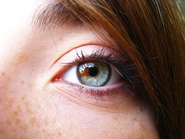 частичная гетерохромия глаз