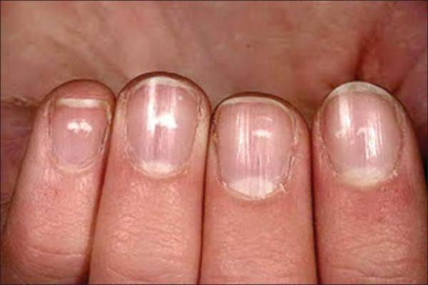 белые пятна на ногтях пальцев рук причина